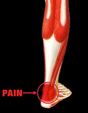 Achilles Tendon Injury