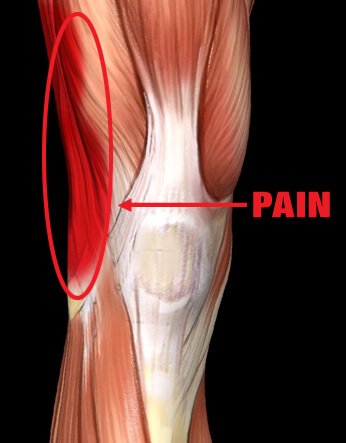 Iliotibial Band Syndrome - Pro-Tec Athletics