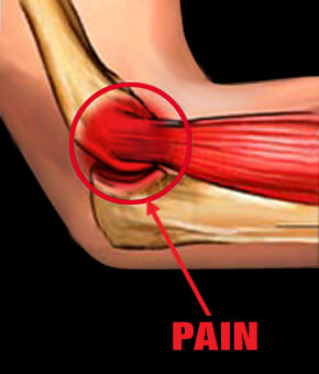 Lateral Epicondylitis