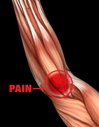 Medial Epicondylitis