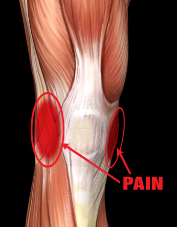 Ligament (MCL) Injury - Pro-Tec Athletics