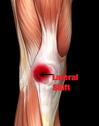 Patellar Subluxation