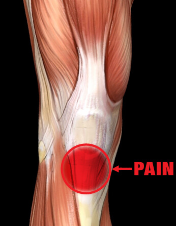 Patellar Tendonitis Pain