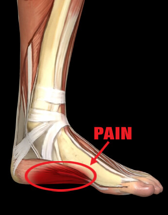 Plantar Fasciitis