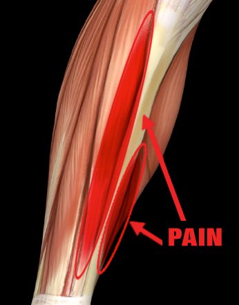 Shin Splint